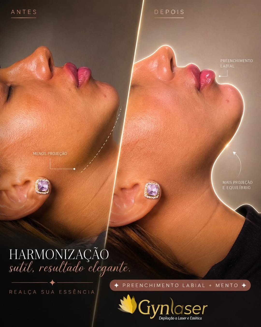 Antes e Depois da Harmonização Labial de Luxo com 1ml de preenchimento