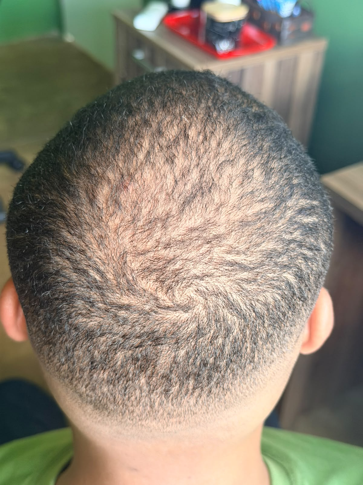 Antes: registro da parte superior e posterior do cabelo